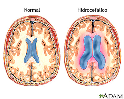 Hidrocefalia. La cirugía para la demencia tratable podría también ayudar en el Alzheimer.