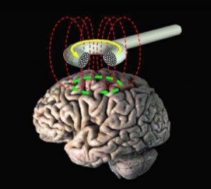 Un estudio apunta terapias magnéticas para enfermos de Alzheimer
