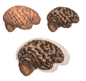 Nuevo test en sangre detectaría el Alzheimer.