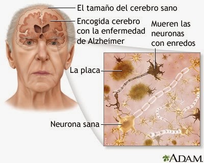 Fases del Alzheimer Bien Explicadas