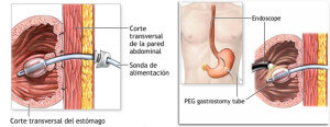 Atender Necesidades de los Mayores. Gastrostomia