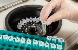 La Detección Precoz del Alzheimer Mediante Biomarcadores