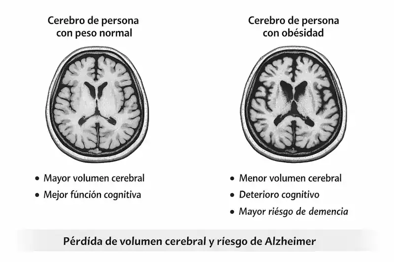 Comparación ilustrativa del cerebro en obesidad y peso normal mostrando relación con atrofia cerebral y Alzheimer