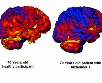 Tamaño del cerebro para predecir la enfermedad de Alzheimer
