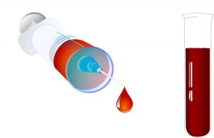 Pistas del alzhéimer en sangre, ¿un paso más en el diagnóstico?