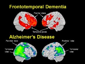 Demencia Frontotemporal. Diagnóstico y Tratamiento