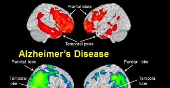 Demencia Frontotemporal. Diagnóstico y Tratamiento