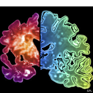Comparación del tejido de un cerebro con demencia y uno normal.