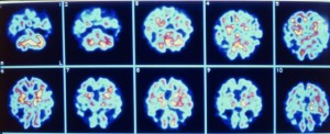Imágenes de un cerebro con alzhéimer. / AGE FOTOSTOCK
