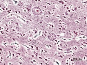 Corte histológico de corteza cerebral con Alzheimer (tinción con plata) donde se observan las placas seniles (Fuente: Wikipedia Autor: KGH)