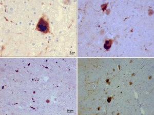 Corte histológico de la substancia negra de un cerebro con Parkinson. Las manchas marrones son los llamados cuerpos de Lewy, inclusiones anómalas de la proteína alfa sinucleína en unión con otras proteínas en las neuronas pigmentadas (Fuente: Wikipedia Autor: Suraj Rajan)