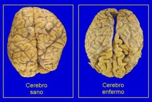 Proteina TDP-43, un nuevo descubrimiento ¿Por qué algunos enfermos de alzhéimer mueren sin deterioro cognitivo y otros no? Una tercera proteína ofrece pistas.