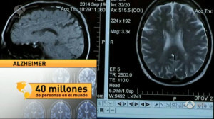 El 80% de las Personas que Padecen Alzheimer Leve no lo Sabe