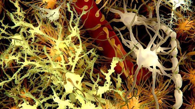Las placas amiloides (amarillo) se encuentran en el cerebro de personas con síndrome de Down y enfermedad de Alzheimer. Imagen: J.GARTNER