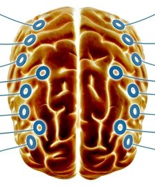 La estimulación cerebral profunda podría ayudar a curar enfermedades como el alzheimer o la depresión GYI