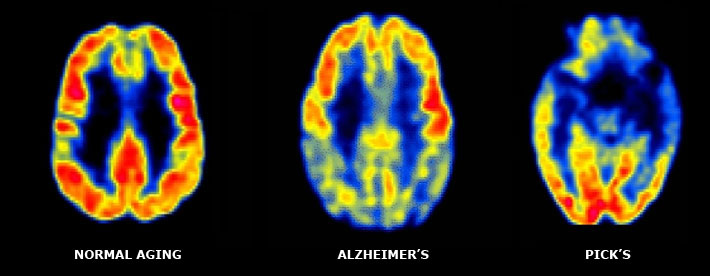 diferencia-alzheimer-pick1