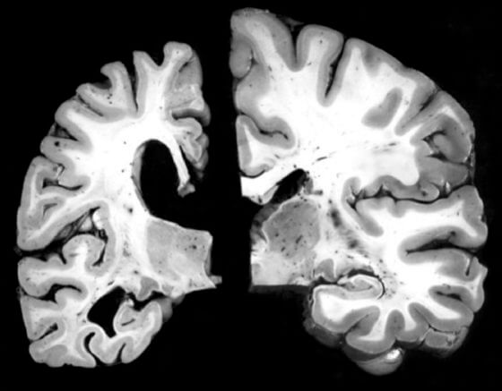 Comparación del cerebro de una persona con alzhéimer, a la izquierda, y otra sana / WASHINGTON UNIVERSITY