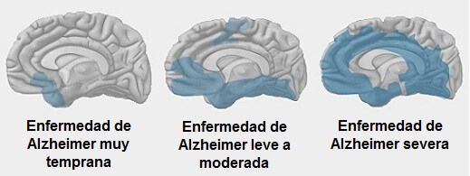 Hablando Claro: Hablando del Alzheimer. Hablando Claro: Hablando del Alzheimer.