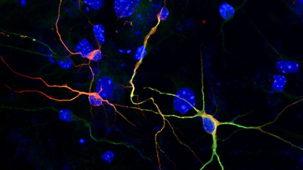 Tratamiento químico transforma células en neuronas. Tratamiento químico transforma células de la piel en neuronas - DR. WENXIANG HU Una neurona humana, transformada desde una célula de la piel por un cóctel químico.