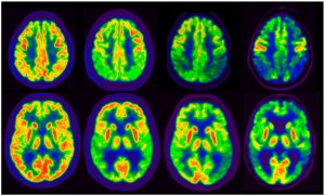 Imágenes PET con 18 F-FDG de la progresión de la neurodegeneración en la EA. De izquierda a derecha: imagen normal, deterioro cognitivo ligero secundario a EA, fase inicial de demencia por EA y fase avanzada de demencia por EA (cortesía de la Clínica Universidad de Navarra, Pamplona).