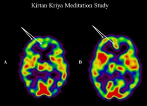 Yoga y Meditación frente a Olvidos iniciales.