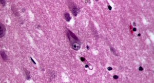 LMTX medicamento experimental que ataca las proteínas tau