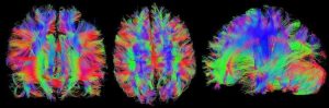 Cuáles son los Síntomas del Alzheimer Avanzado (Primera parte)