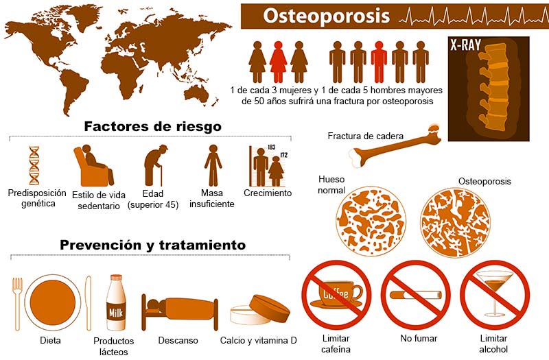 Alzheimer y Fracturas de Cadera - infografía Osteoporosis-3