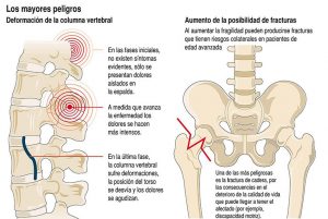 infografía Osteoporosis-2