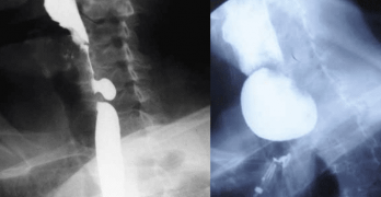 Guía de Diagnóstico y Tratamiento Nutricional y Rehabilitador en Disfagia Orofaríngea
