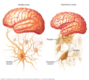 El Alzheimer no Puede con el Área del Cerebro que Guarda la Música