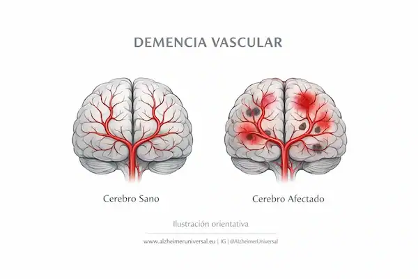 demencia vascular cerebro flujo sanguineo reducido daño cerebral